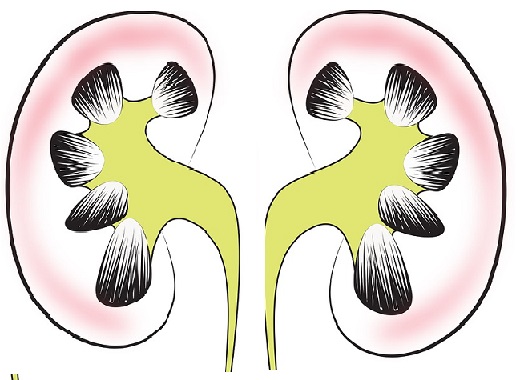 kidney transplant complications