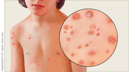 skin rash diagnosis chicken pox