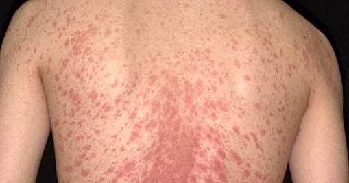 Common Skin Rashes Diagnose Your Skin Problem Fever Pk