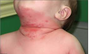 skin rash diagnosis 