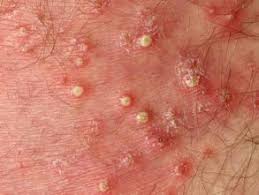 skin rash diagnosis folliculitis