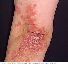 skin rash diagnosis psoriasis