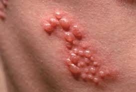 skin rash diagnosis shingles
