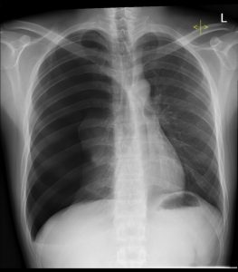 pneumothorax can be fatal if misdiagnosed