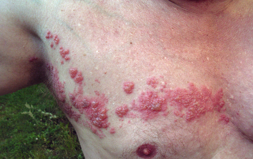 herpes zoster or shingles