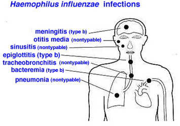 Hemophilus influenza vaccination