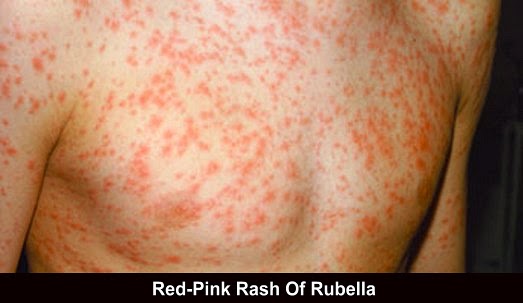 rubella or german measles