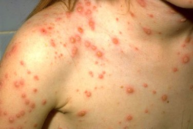 chickenpox/ varicella
