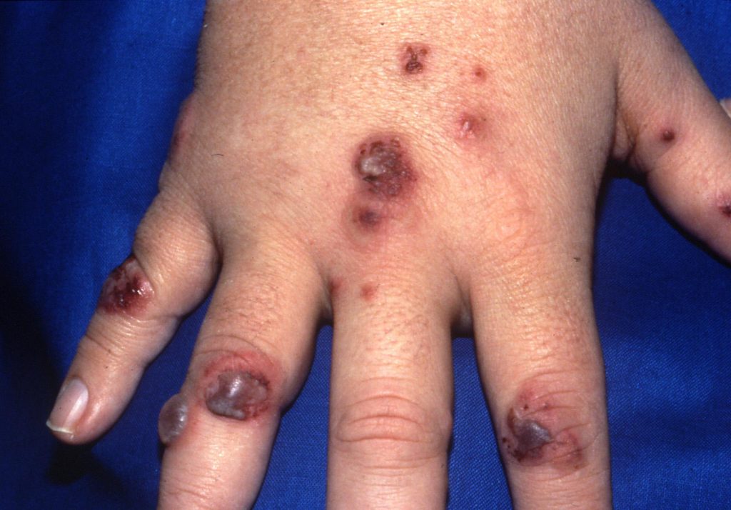 wegener's granulomatosis