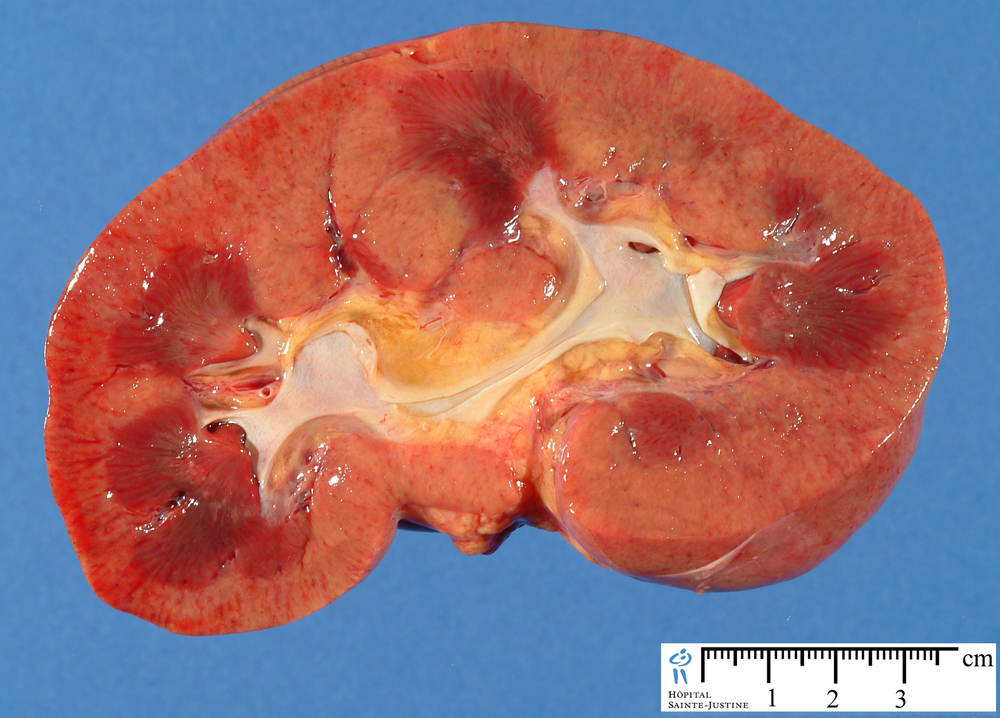 kidney involvement in wegener's granulomatosis