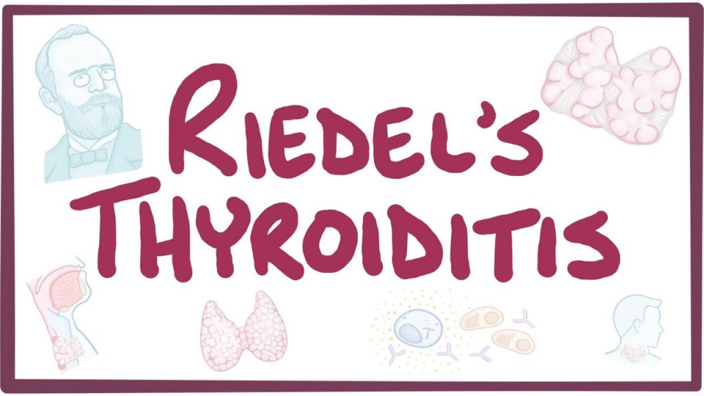 reidel's thyroiditis