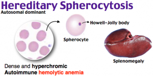 hereditary spherocytosis