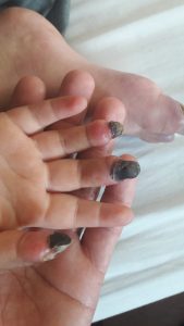 gangrene of fingertips