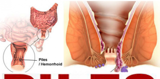 how to prevent and treat hemorrhoids