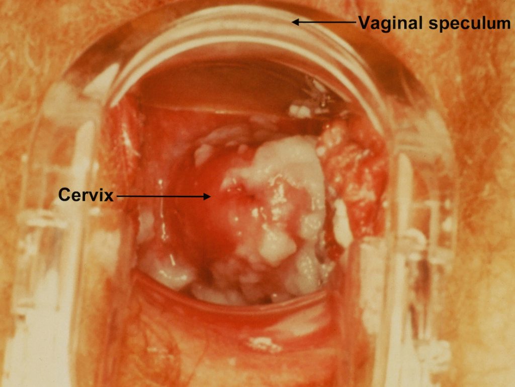 vaginal yeast infection