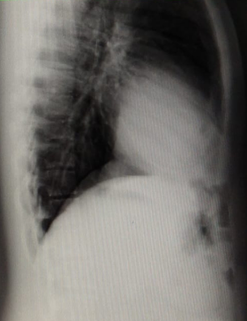 chest x ray bouts of cough