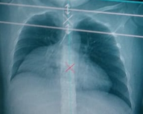 chest radiograph morgagni hernia